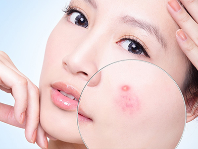 Bật mí chiêu chăm sóc da khi bị mụn