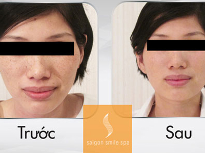 20 cơ hội Miễn phí trị nám, tàn nhang với công nghệ Laser Revlite chính hãng Hoa Kỳ