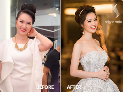Top 3 phương pháp giảm béo được yêu thích năm 2016