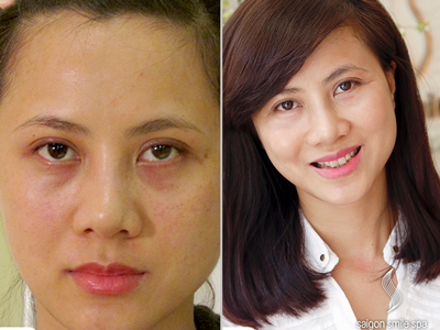 Trị nám bằng Laser: Công nghệ chỉ quyết định 50%