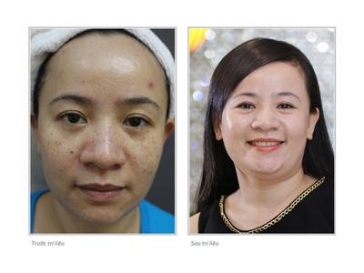 Những nữ công sở trị nám tại Saigon Smile Spa