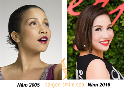“Lột xác” sau khi trị nám tại Saigon Smile Spa