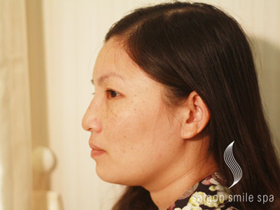 Nhật kí trị nám của bà mẹ 2 con
