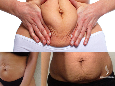 Giảm béo bằng dao kéo không khác nào sinh mổ lần 2
