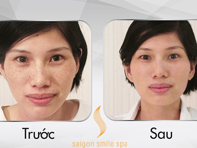 Xoá tàn nhang công nghệ Mỹ