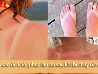 Khôi phục làn da trắng sáng sau khi đi biển chỉ 1 tuần