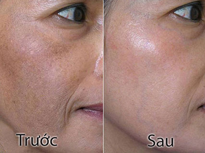 Trị nám