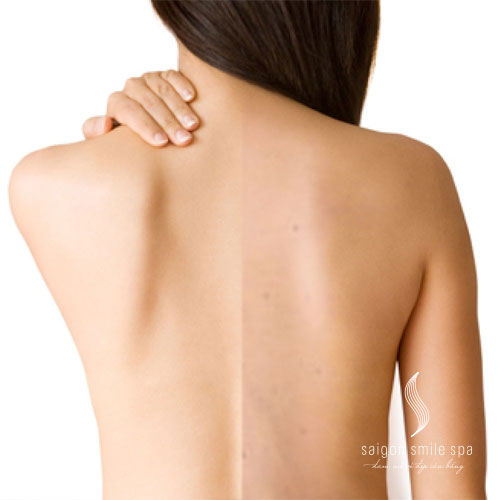 Trị mụn vùng lưng, vai