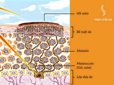 Sai lầm của phụ nữ khi trị nám mùa hè