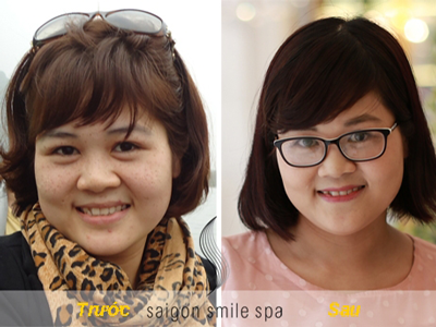 Triệt tiêu nám, tàn nhang không tái phát