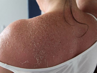 Hiểm họa khi tắm trắng tại nhà không đúng cách