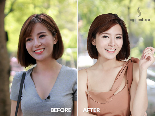 Làm đẹp cao cấp giá thấp nhất năm tại Saigon Smile Spa