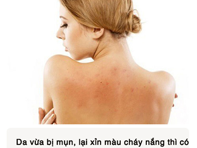 Cách nhanh nhất để tắm trắng da toàn thân chỉ 2 tuần