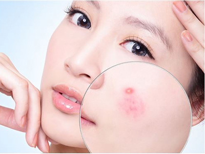 Không còn khổ sở vì nám da nếu biết cách trị nám da này