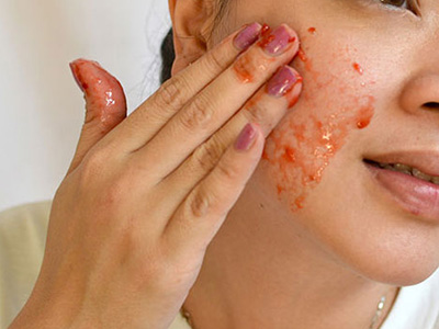 Mặt nạ vừa trị mụn, vừa làm trắng da từ cà rốt