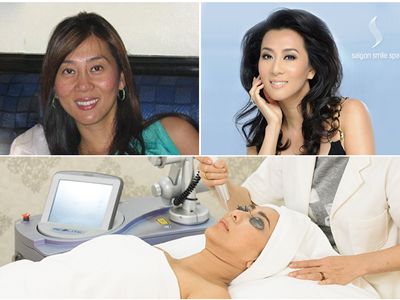 Kinh nghiệm trị nám không tái phát của 20.000 phụ nữ Việt