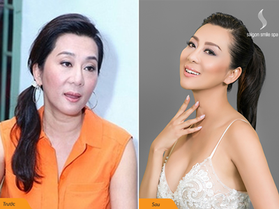 Chữa sụp mí mắt, nâng cung mày sau 1 lần trị liệu