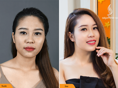 Không phần mềm 360 độ, da trắng trong veo chỉ sau 90 phút