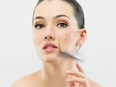 Trị mụn không đau – hạn chế vết thâm
