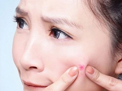 Trị mụn tại nhà sử dụng cách tự nhiên
