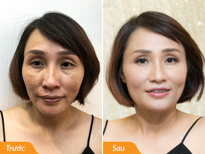 Xóa tàn nhang và nám hỗn hợp lâu năm với công nghệ từ Mỹ