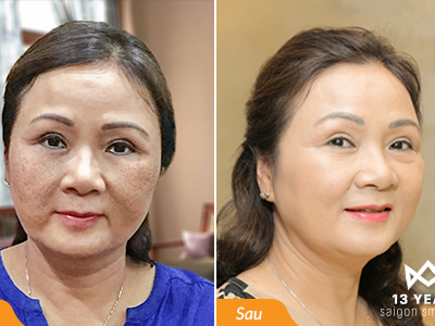 Mỹ nhân Hà Thành thoát 25 năm nám chân sâu chỉ sau 3 buổi