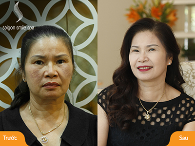 Thoát 25 năm nám, tàn nhang đôi bạn trung niên “trẻ hơn tuổi thật”
