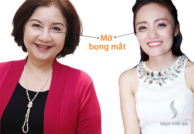 45 phút xoá tan bọng mắt, chảy xệ, thâm quầng