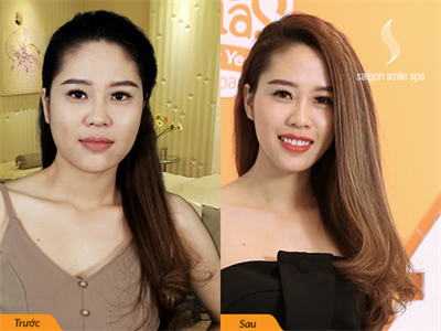 Chưa già nhưng đã lão hóa, mắt nhăn, da chùng & cằm to bạnh