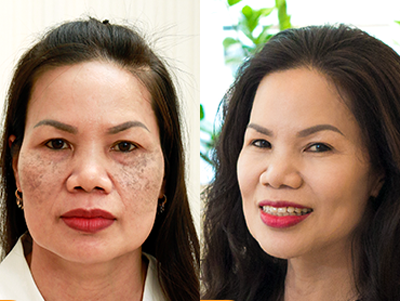 Hoảng hốt khi nám thâm cả mặt vì sai lầm “vái tứ phương”