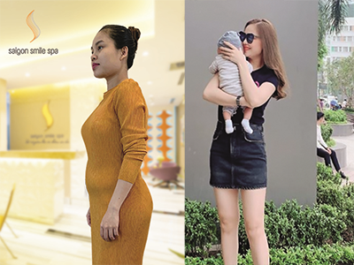 Cơ hội sở hữu liệu trình giảm béo miễn phí tại Saigon Smile Spa