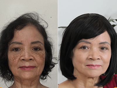 Tài trợ 100 suất kiểm chứng hiệu quả trị nám của bác sỹ Mỹ