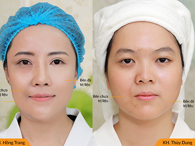 Trẻ hóa, xóa nhăn, tạo mặt V-line công nghệ mỹ Ultherapy