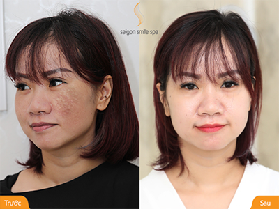 Trị nám, tàn nhang không tái phát nhờ 1 bản cam kết