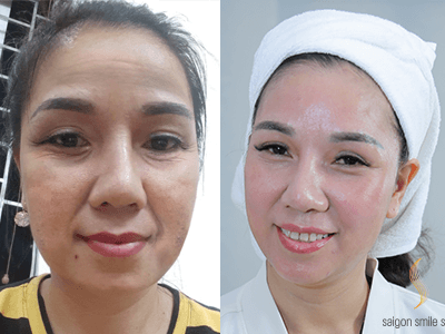 Chị em Hà Nội – Sài Gòn đổ xô đi trẻ hóa da