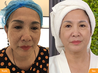 3 nguyên tắc vàng cần nhớ trước khi chi tiền trị nám