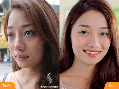 Cô dâu tranh thủ trị nám ngày hội giá thấp nhất năm