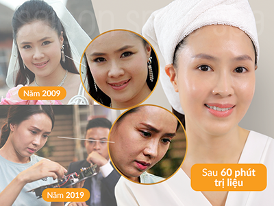 “Nghi án” Hồng Diễm phẫu thuật căng da, xóa nhăn