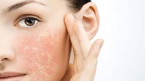 Nhận biết da nhạy cảm và cách làm trắng da nhạy cảm hiệu quả