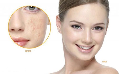 Bị nám không nên ăn gì ?