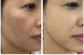 Nguyên nhân và cách trị nám da tay