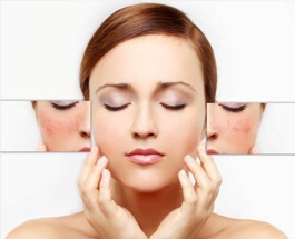 Trị nám nhanh tại nhà bằng lá tía tô