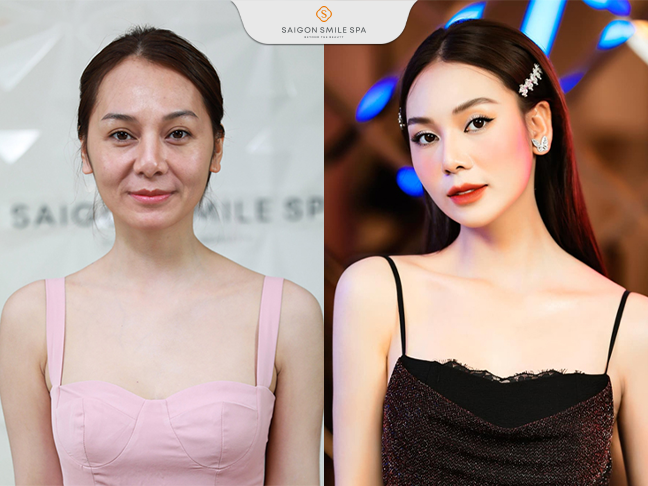Hot tiktoker Kim Chi Hoàng chọn “sửa mặt” không dao kéo