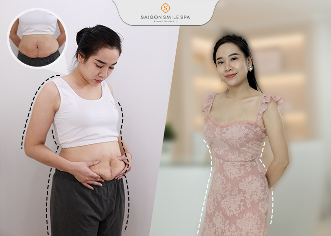“Sửa dáng” cấp tốc cho hàng ngàn nhân viên văn phòng