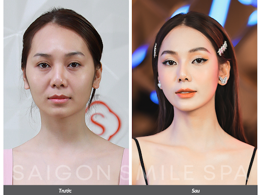 Theo chân hội chị em đi tìm bí quyết làm đầy thái dương dứt điểm cực uy tín