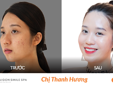 Các TIPS trị nám nhanh chóng mà chị em không thể bỏ lỡ trong mùa hè này