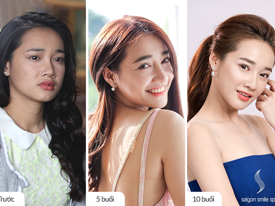 [Review] Trẻ hoá bằng Ultherapy an toàn giúp chị đẹp “hack tuổi” cực đỉnh
