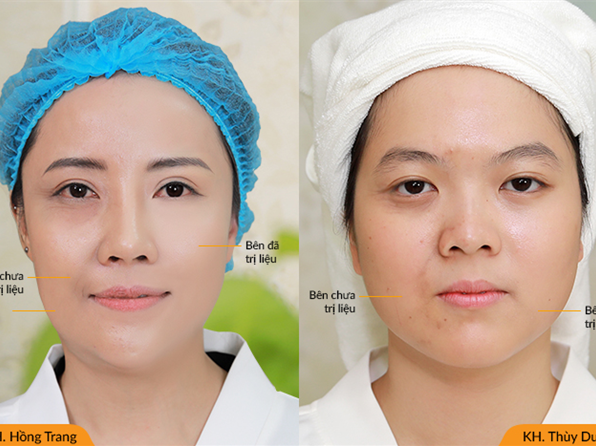 [REVIEW] “CAO THỦ” TRẺ HÓA ULTHERAPY, MÁY ĐI ĐẾN ĐÂU, CƠ MẶT CĂNG – NẾP NHĂN ĐƯỢC LÀ PHẲNG Ở ĐÓ