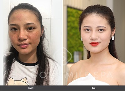 [Review] Chia sẻ bí quyết trị nám của chị em văn phòng | +4 phương pháp trị nám hiện đại không xâm lấn