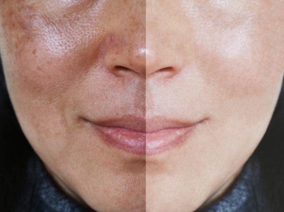 [Review] Làn da sáng hồng nhờ loại bỏ những vết nám bằng “trị nám sinh học đa lớp”